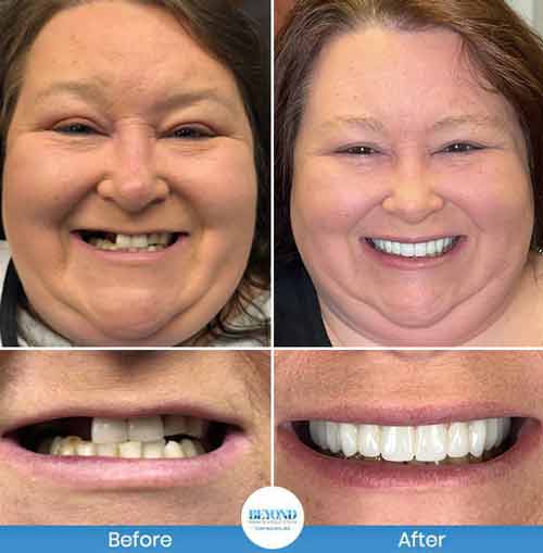 All-on-4 Implants Specialist Near Me in Los Altos, CA and Fort Worth TX