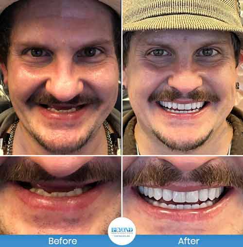 All-on-4 Implants Specialist Near Me in Los Altos, CA and Fort Worth TX