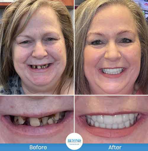 All-on-4 Implants Specialist Near Me in Los Altos, CA