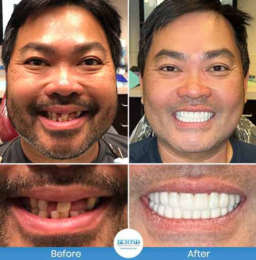 All-on-4 Implants Specialist Near Me in Los Altos, CA