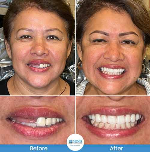 All-on-4 Implants Specialist Near Me in Los Altos, CA