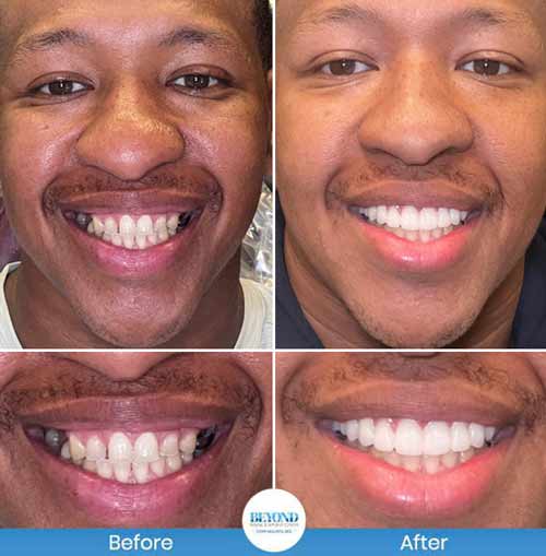 All-on-4 Implants Specialist Near Me in Los Altos, CA