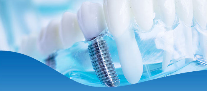 Top Rated Dental Implant Center Near Me in Los Altos, CA Top Rated Dental Implant Center Near Me in Los Altos, CA