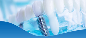 Top Rated Dental Implant Center Near Me in Los Altos, CA Top Rated Dental Implant Center Near Me in Los Altos, CA