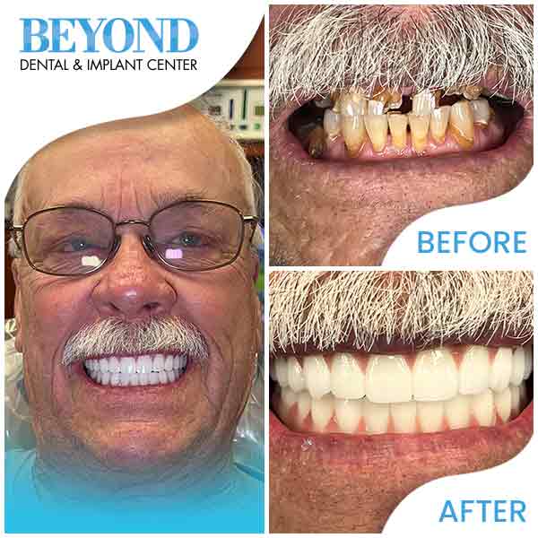 All-On-4® Dental Implants in DFW Area
