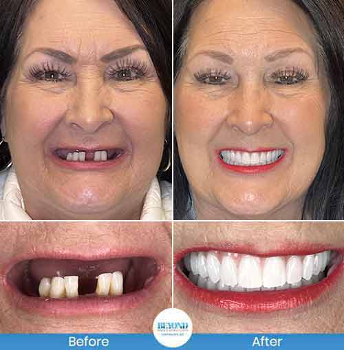 All-on-4 Implants Specialist Near Me in Los Altos, CA