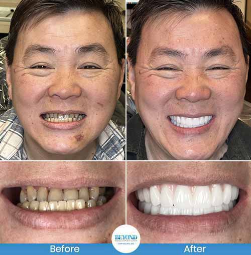 All-on-4 Implants Specialist Near Me in Los Altos, CA