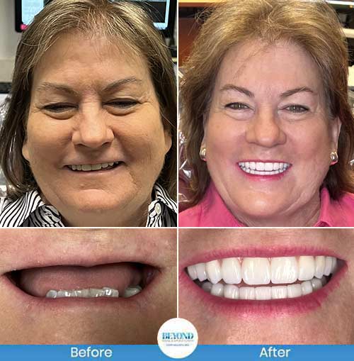 All-on-4 Implants Specialist Near Me in Los Altos, CA