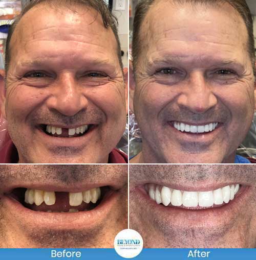 All-on-4 Implants Specialist Near Me in Los Altos, CA