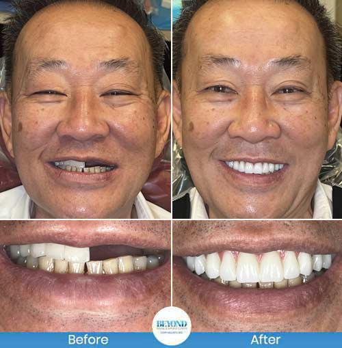 All-on-4 Implants Specialist Near Me in Los Altos, CA