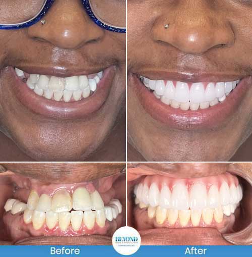 All-on-4 Implants Specialist Near Me in Los Altos, CA