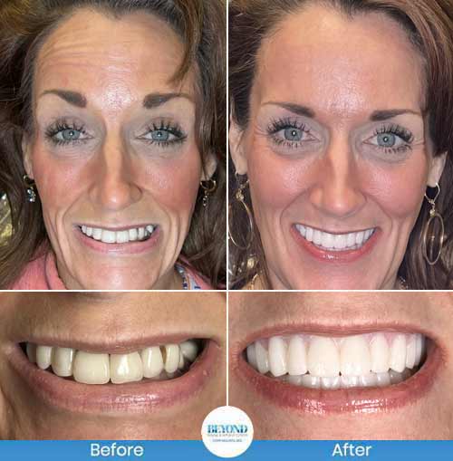 All-on-4 Implants Specialist Near Me in Los Altos, CA