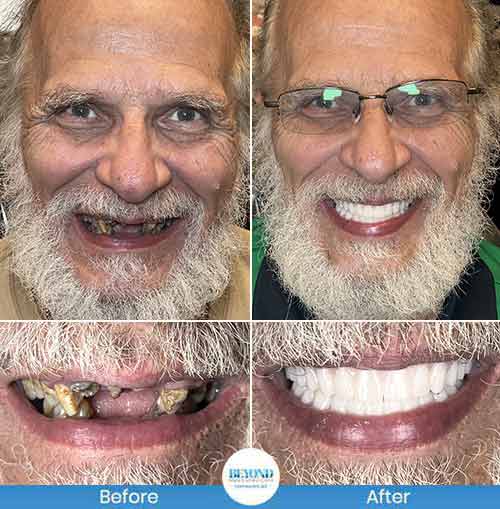 All-on-4 Implants Specialist Near Me in Los Altos, CA