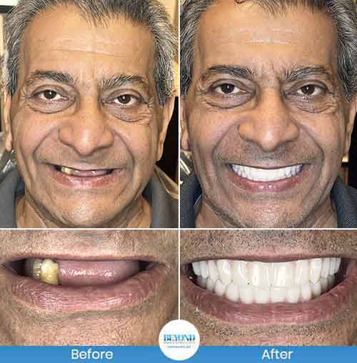 All-on-4 Implants Specialist Near Me in Los Altos, CA