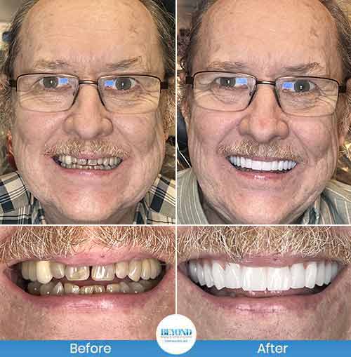 All-on-4 Implants Specialist Near Me in Los Altos, CA