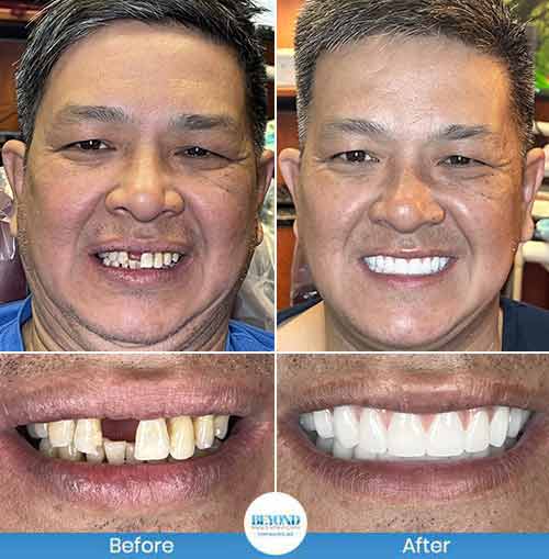 All-on-4 Implants Specialist Near Me in Los Altos, CA