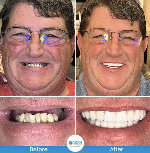 All-on-4 Implants Specialist Near Me in Los Altos, CA