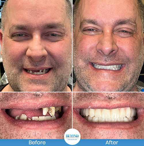 All-on-4 Implants Specialist Near Me in Los Altos, CA