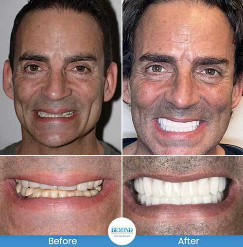 All-on-4 Implants Specialist Near Me in Los Altos, CA