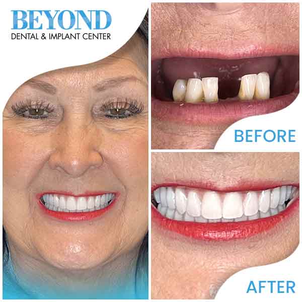 Smile Makeover Before and After Gallery in Los Altos, CA