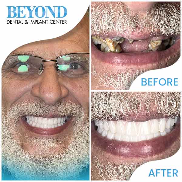 ABC Dental Clinic & Implant Center Real patients, real results and real beautiful new smiles in Los Altos, CA (DFW Area) ABC Dental Clinic & Implant Center Real patients, real results and real beautiful new smiles in Los Altos, CA (DFW Area)