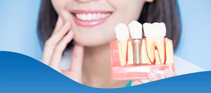 Root Canal Vs Single Tooth Implant in Los Altos, CA Root Canal Vs Single Tooth Implant in Los Altos, CA