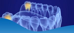 Wisdom Tooth Removal Cost without Insurance Near Me in Los Altos, CA Wisdom Tooth Removal Cost without Insurance Near Me in Los Altos, CA