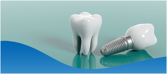 Dental Implants Cost without Insurance Near Me in Los Altos, CA Dental Implants Cost without Insurance Near Me in Los Altos, CA