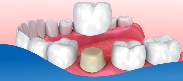 Everything You Need to Know About Getting a Dental Crown Near Me in Los Altos, CA Everything You Need to Know About Getting a Dental Crown Near Me in Los Altos, CA