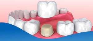 Everything You Need to Know About Getting a Dental Crown Near Me in Los Altos, CA Everything You Need to Know About Getting a Dental Crown Near Me in Los Altos, CA