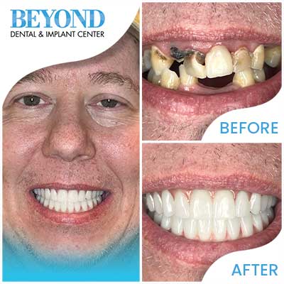 All-On-4® Dental Implants in DFW Area