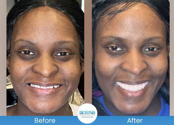 All-on-4 Implants Specialist Near Me in Los Altos, CA