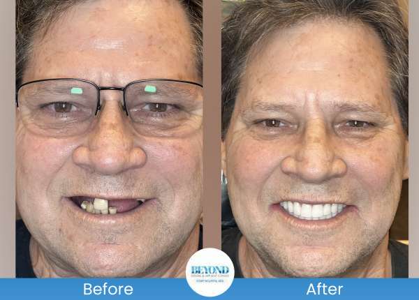 All-on-4 Implants Specialist Near Me in Los Altos, CA