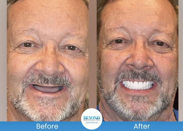 All-on-4 Implants Specialist Near Me in Los Altos, CA