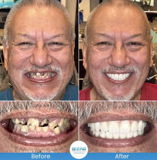 All-on-4 Implants Specialist Near Me in Los Altos, CA