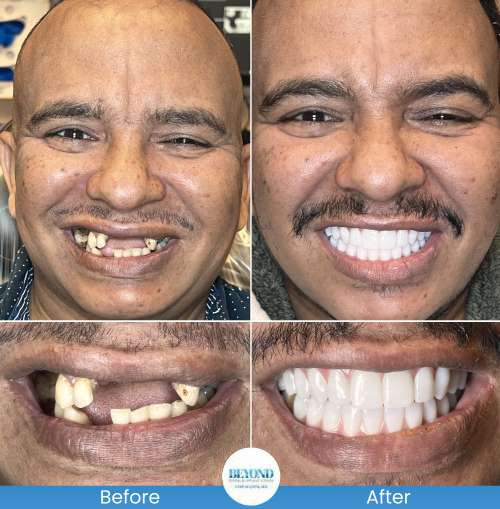 All-on-4 Implants Specialist Near Me in Los Altos, CA