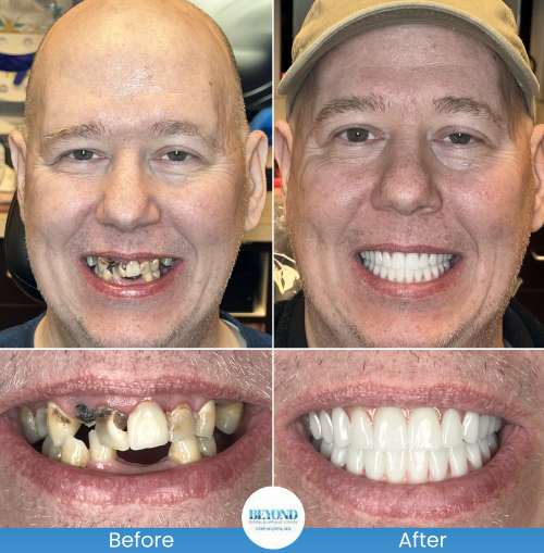 All-on-4 Implants Specialist Near Me in Los Altos, CA