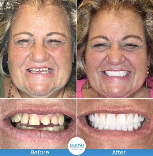 All-on-4 Implants Specialist Near Me in Los Altos, CA