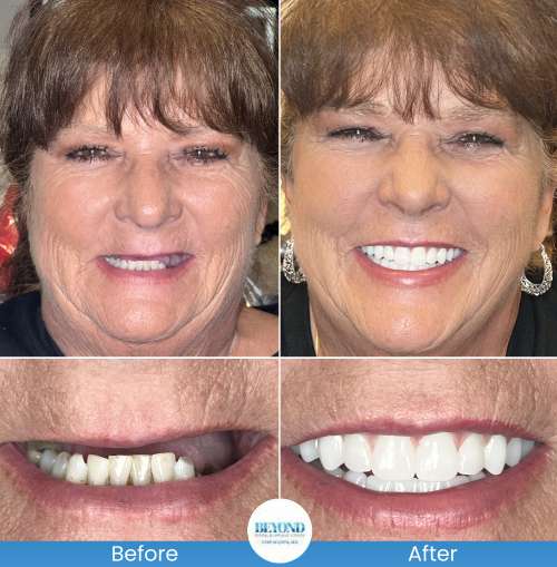 All-on-4 Implants Specialist Near Me in Los Altos, CA