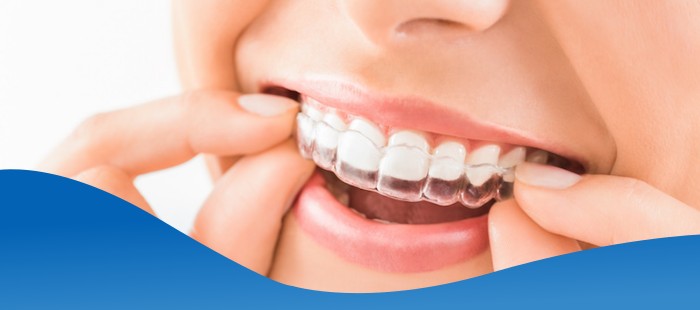 How Much Does Insurance Cover for Invisalign Near Me in Los Altos, CA How Much Does Insurance Cover for Invisalign Near Me in Los Altos, CA