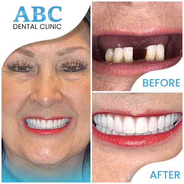 ABC Dental Clinic Real patients, real results and real beautiful new smiles in Los Altos, CA