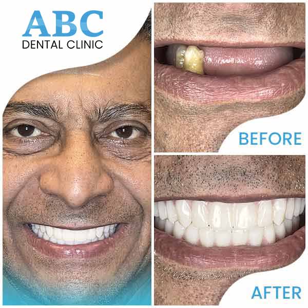 ABC Dental Clinic Real patients, real results and real beautiful new smiles in Los Altos, CA